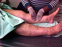 Foto de 
uma voluntária fazendo massagem na perna de uma paciente