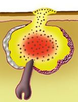 Foto: site www.saudetotal.com.br/acne/acne/formacao.asp