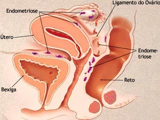 Ilustração sobre endometriose