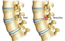 Resultado de imagem para hernia de disco lombar