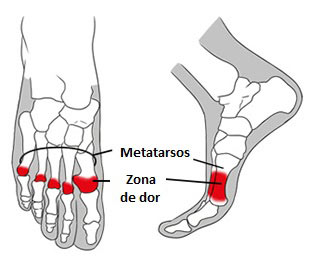 Imagem: divulgação/http://www.pessemdor.com.br/dores/diagnostico-de-dores/metatarsalgia/