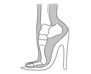 Imagem: divulgação/http://www.pessemdor.com.br/dores/diagnostico-de-dores/metatarsalgia/