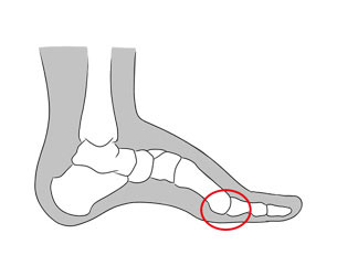 Imagem: divulgação/http://www.pessemdor.com.br/dores/diagnostico-de-dores/metatarsalgia/