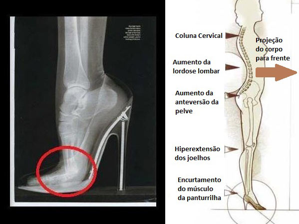 Imagem: divulgação/http://jorgecoluna.com.br/o-salto-alto-e-a-coluna-vertebral/