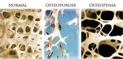Entenda o que &eacute; a Osteopenia