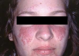 lupus eritematos care este această boală articulară celadrin pret emag