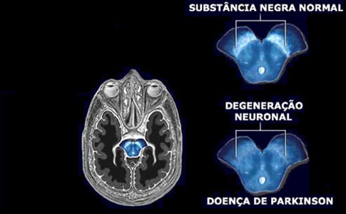 Resultado de imagem para doenÃ§a de parkinson