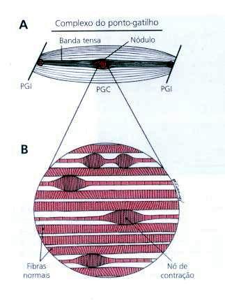 Foto: Divulgação/http://mioterapia.blogspot.com/