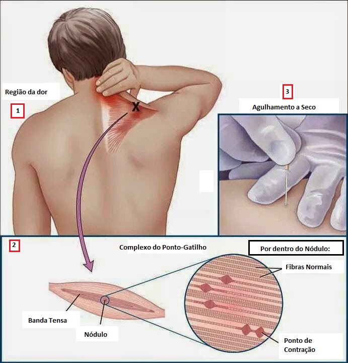 Foto: Divulgação/https://jornalismoufpi.blogspot.com/2017/06/?view=classic