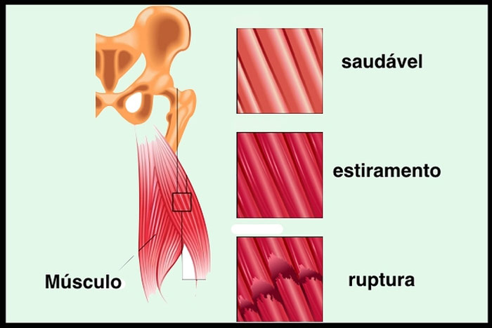 Foto: Divulgação/http://saude.culturamix.com/tratamento/distensao-muscular-fisioterapia