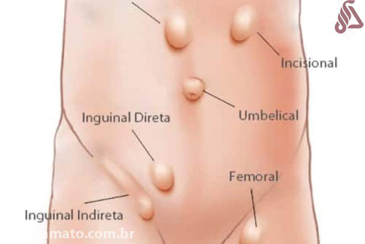 https://www.amato.com.br/content/o-que-%C3%A9-h%C3%A9rnia-h%C3%A9rnia-umbilical-h%C3%A9rnia-inguinal-e-outras