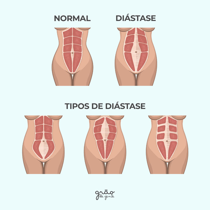 http://www.bloggraodegente.com.br/gravidez/diastase-abdominal-pos-parto/